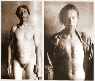 Removal of Genitals and Breasts
